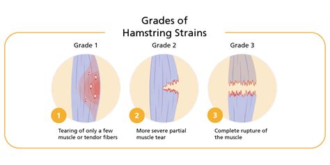 hamstring test for tear|how to grade hamstring strain.